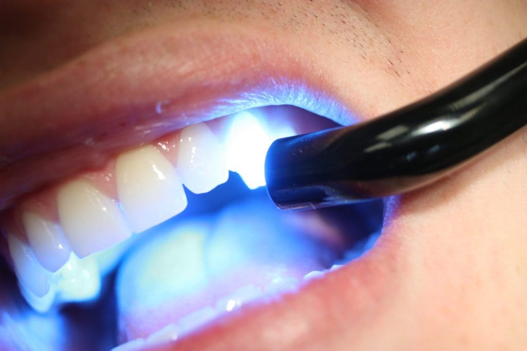 Composite fillings picture for murfreesboro dentist Dr. Elizabeth Jackson