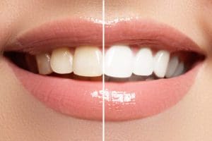 teeth whitening murfreesboro
